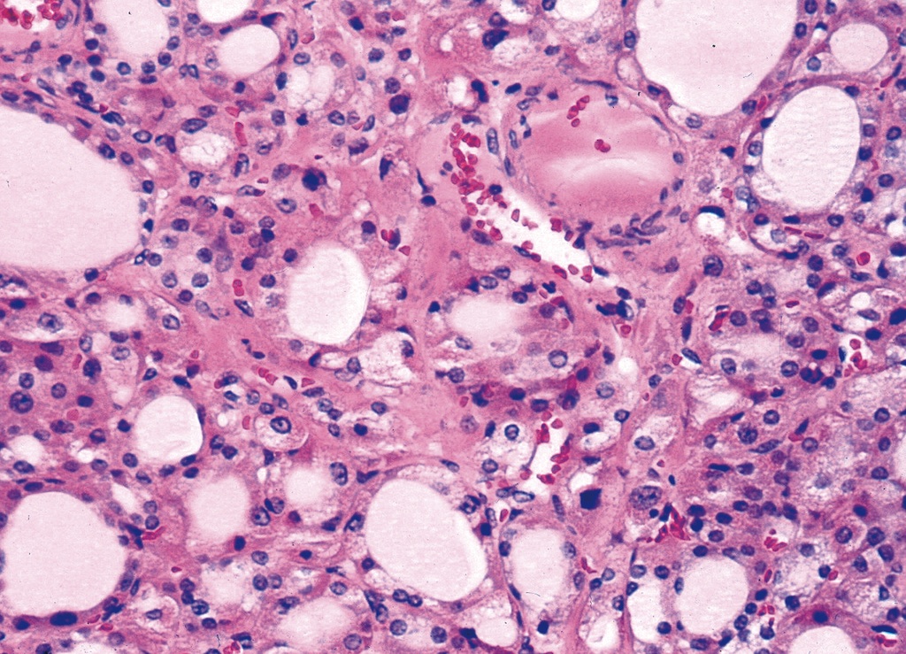 Pathology Outlines Oncocytic (Hürthle cell) tumors